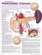 Understanding Pancreatic Cancer Anatomical Chart (en Inglés)