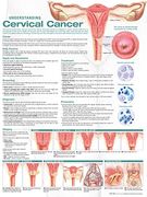 Understanding Cervical Cancer Anatomical Chart (en Inglés)