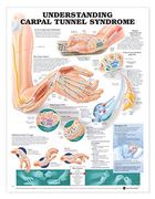 Understanding Carpal Tunnel Syndrome Anatomical Chart (en Inglés)
