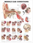 Middle ear Conditions Anatomical Chart