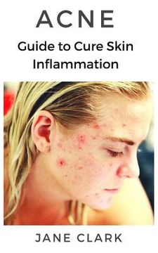 portada Acne: Guide to Cure Skin Inflammation (en Inglés)