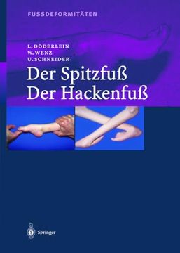 portada Fussdeformitäten: Der Spitzfuß (en Alemán)