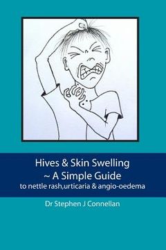 portada Hives & Skin Swelling A Simple Guide: to nettle rash, urticaria & angio-oedema