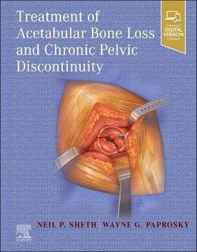 portada Treatment of Acetabular Bone Loss and Chronic Pelvic Discontinuity (en Inglés)