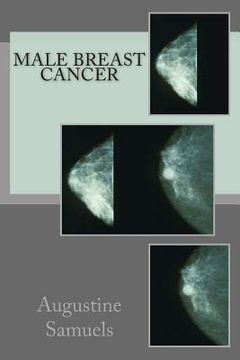 portada Male Breast Cancer (in English)