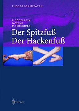 portada Fussdeformitäten: Der Spitzfuss (en Alemán)