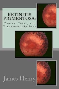 portada Retinitis Pigmentosa: Causes, Tests, and Treatment Options (in English)