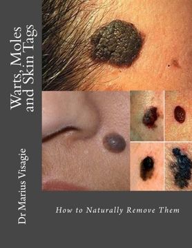 portada Warts, Moles and Skin Tags: How to Naturally Remove Them