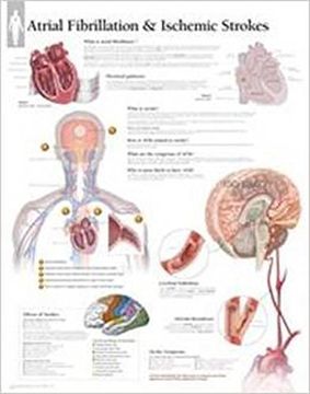 portada Atrial fib & Ischemic Strokes Paper Poster (Anatomical Wall Charts) (en Inglés)