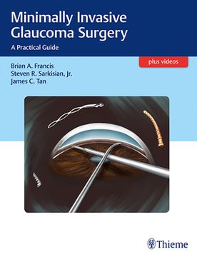 Minimally Invasive Glaucoma Surgery: A Practical Guide (en Inglés)