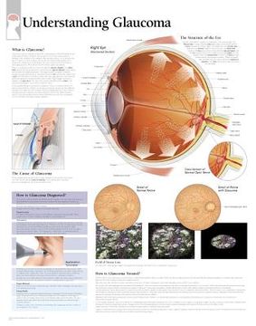 portada understanding glaucoma chart: wall chart