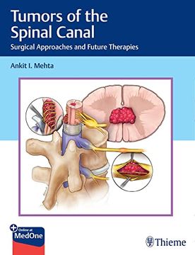 portada Tumors of the Spinal Canal: Surgical Approaches and Future Therapies (en Inglés)