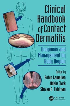 portada Clinical Handbook of Contact Dermatitis: Diagnosis and Management by Body Region (en Inglés)
