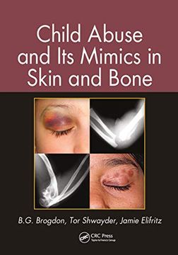 portada Child Abuse and its Mimics in Skin and Bone (en Inglés)