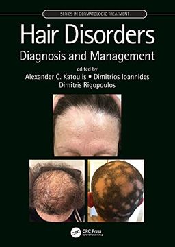 portada Hair Disorders: Diagnosis and Management (Series in Dermatological Treatment) (en Inglés)