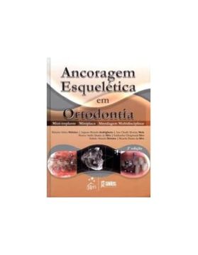 Ancoragem Esquelética em Ortodontia (en Portugués)