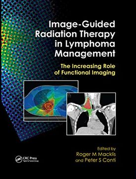 portada Image-Guided Radiation Therapy in Lymphoma Management (in English)