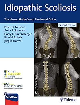 portada Idiopathic Scoliosis: The Harms Study Group Treatment Guide (en Inglés)