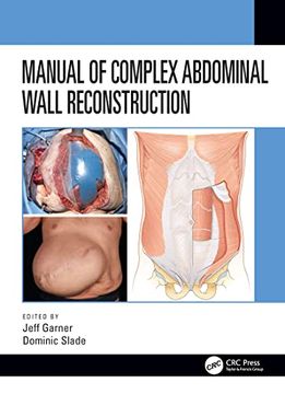 portada Manual of Complex Abdominal Wall Reconstruction (en Inglés)