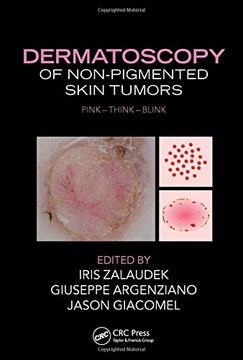 portada Dermatoscopy of Non-Pigmented Skin Tumors: Pink-Think-Blink (in English)