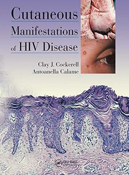 portada Cutaneous Manifestations of hiv Disease (in English)