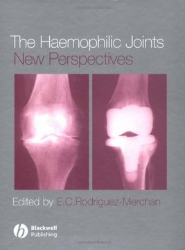 portada the haemophilic joints: new perspectives (en Inglés)