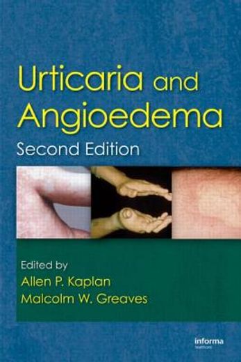 Urticaria and Angioedema (en Inglés)