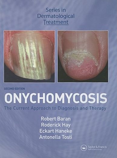 oncychomycosis,the current approach to diagnosis and therapy