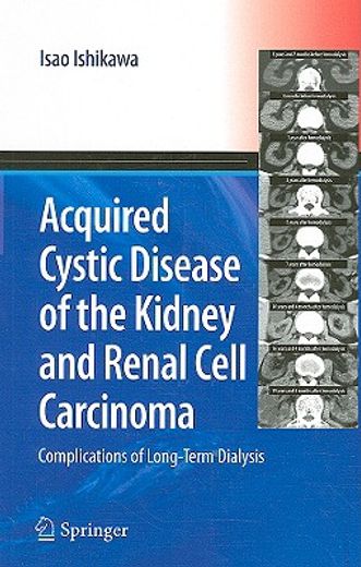 acquired cystic disease of the kidney and renal cell carcinoma,complication of long-term hemodialysis