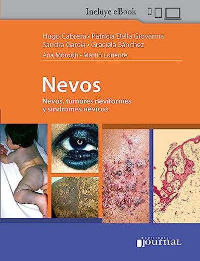 Nevos. Nevos, Tumores Neviformes y Síndromes Névicos