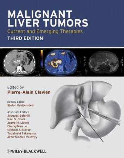 Malignant Liver Tumors: Current and Emerging Therapies (en Inglés)