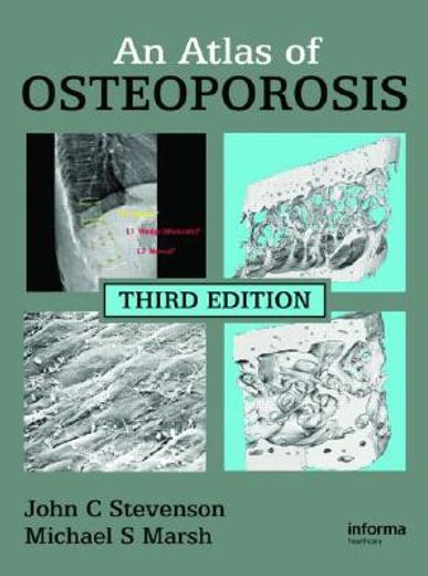 an atlas of osteoporosis