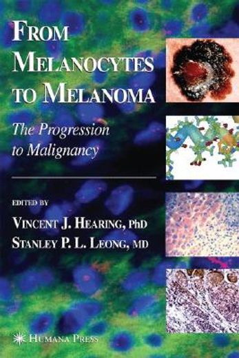 from melanocytes to melanoma,the progression to malignancy