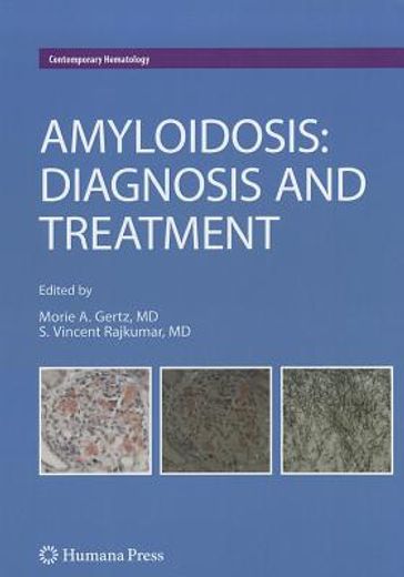 Amyloidosis: Diagnosis and Treatment (en Inglés)